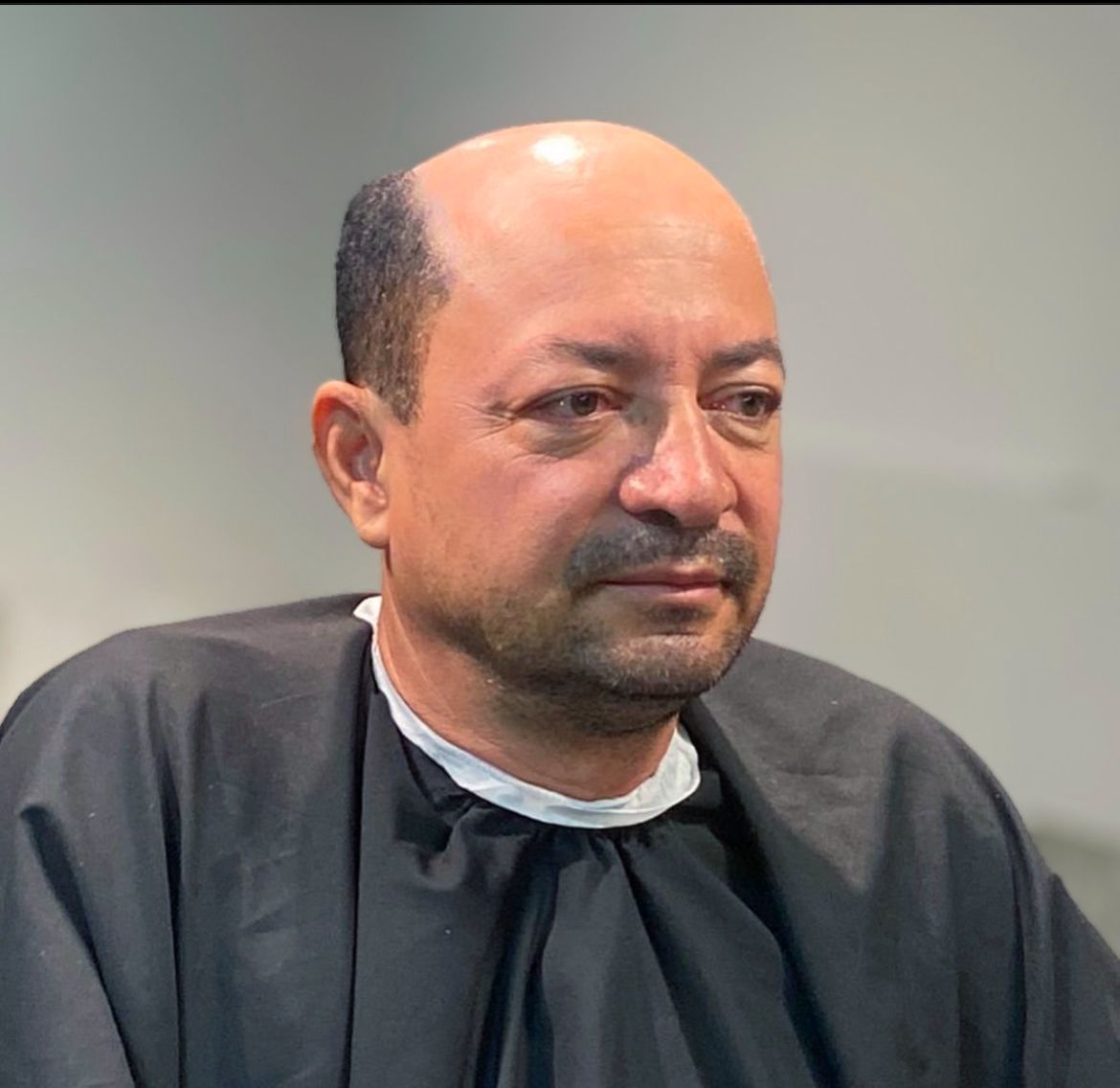 Resultado natural de prótese capilar